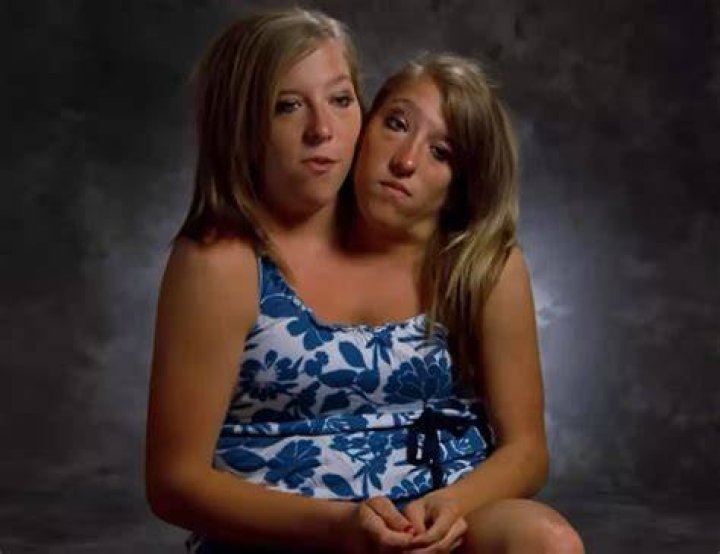 Bateson Conjoined Twins Are A ‘Miracle’ As Parents Share, Photos On Reddit