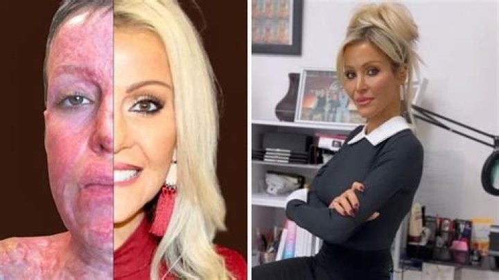 
Dana Vulin An Acid Attack Victim On A Quest To Make Scars Sexy In Lingerie Transformation 