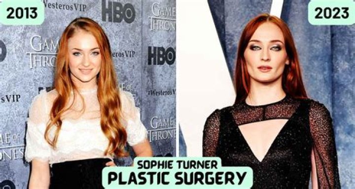 
Did Sophie Turner Get Plastic Surgery? Who is Sophie Turner? 