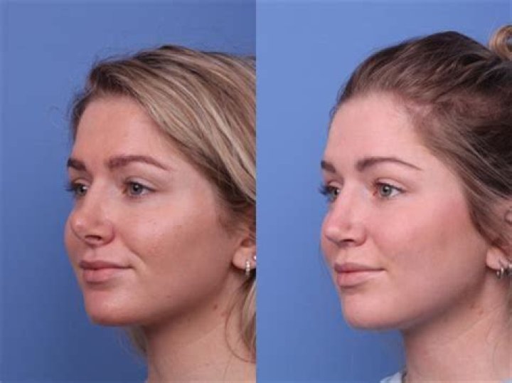 Holly Madison Nose Job Details – Before and After Photos and Plastic Surgery Explained