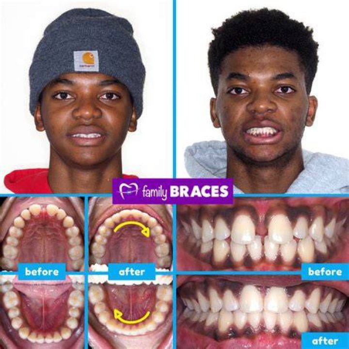 Justin Swanstrom Teeth Before And After Photos, Has He Used Braces Costing $20K?