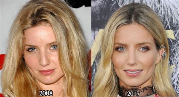 Truth About Annabelle Wallis Nose Job